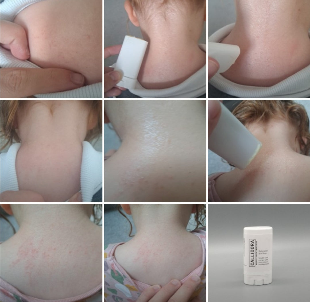 This image shows the stick being used with before and after shots. The skin has cleared up! 